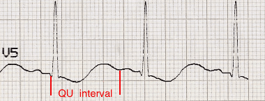 ECG QU interval Hypokalemia