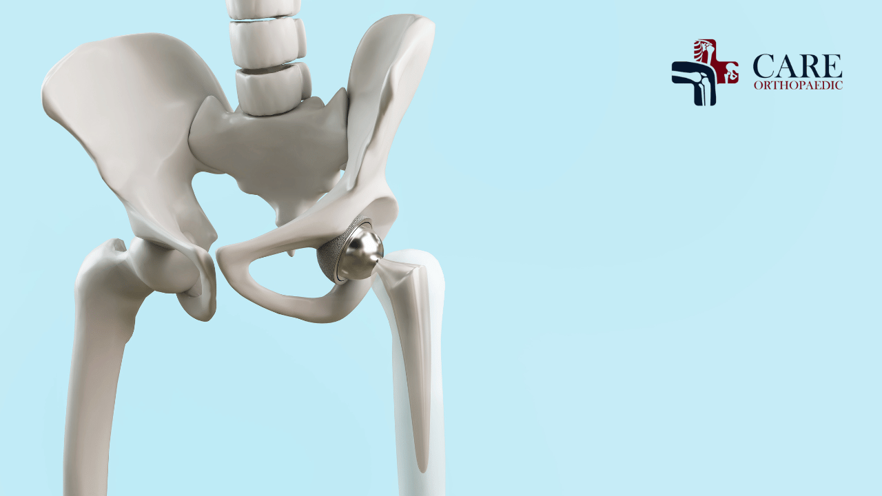 Hip Replacement Surgeon