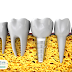 Trồng răng Implant sau nhổ răng