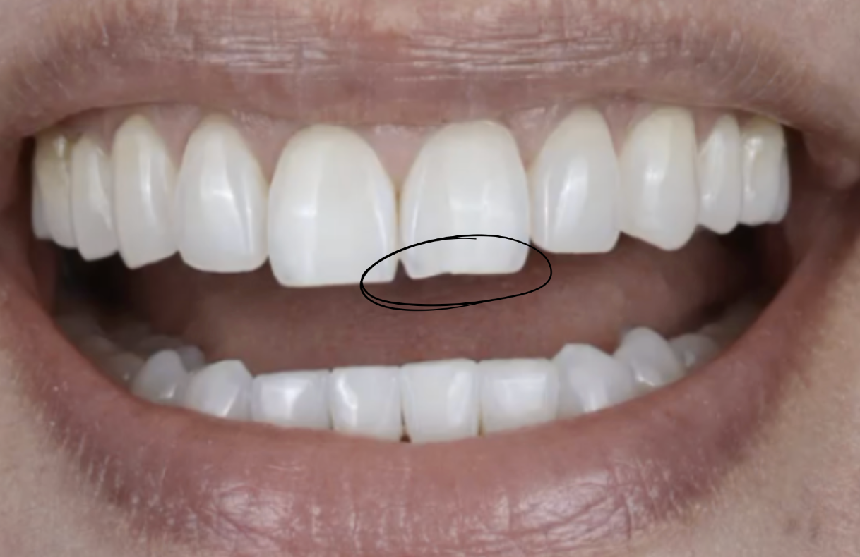 A chipped tooth that needs contouring 