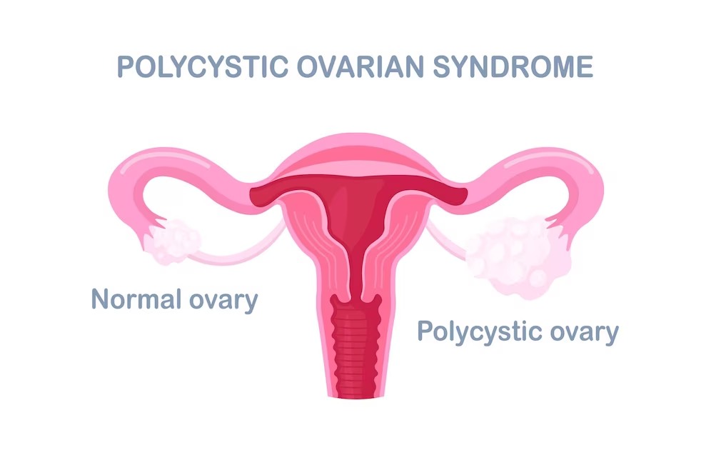 PCOS Ovary image