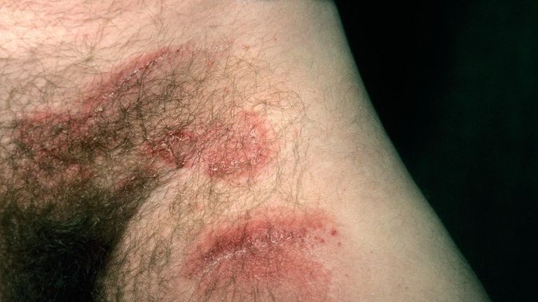 Skin-Conditions-You-Should-Know-About-09-Jock-Itch-RM-1440x810