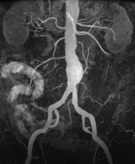 Abdominal aortic aneurysm (MRA, MRI) | Image | Radiopaedia.org