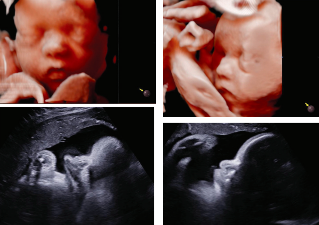 échographie mouvement foetus