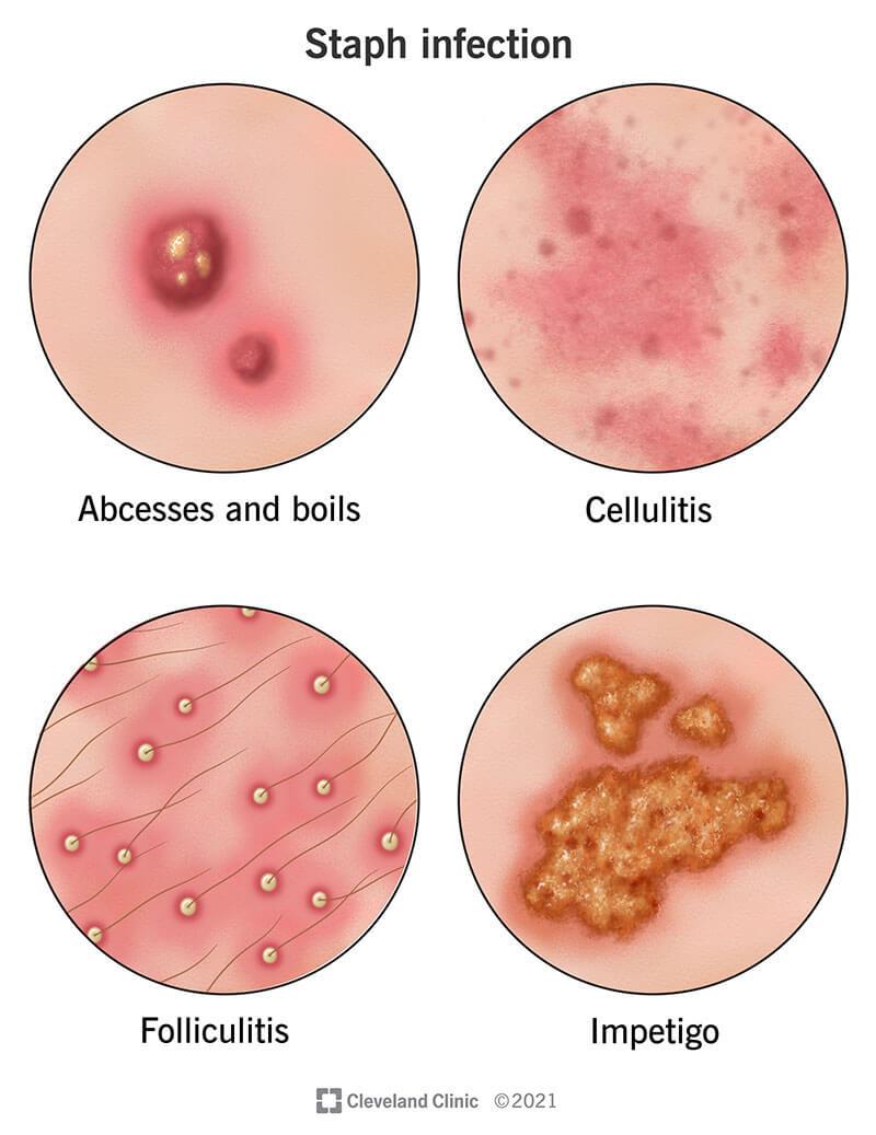 Staph Infection: Causes, Symptoms, Diagnosis & Treatment