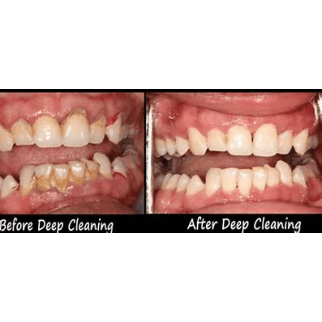 Revolutionize Oral Health with SmileStudio: Why Deep Dental Cleaning is Essential