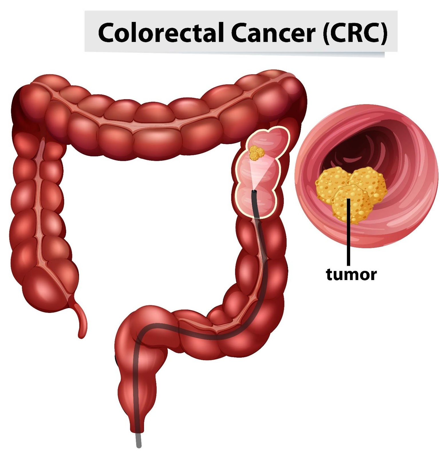 Addressing Colorectal Cancer