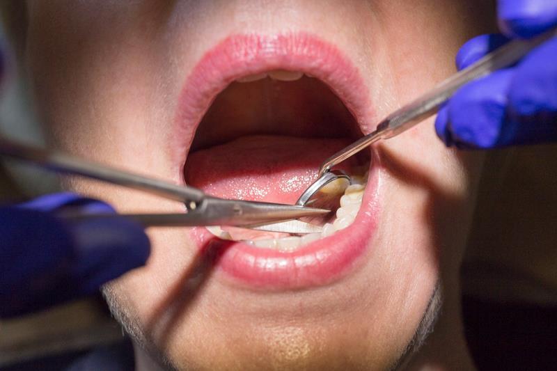 affordable wisdom teeth removal Toronto