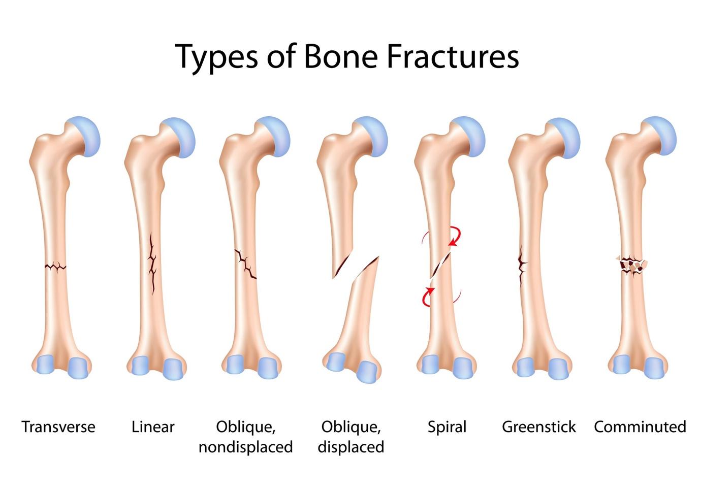 types-of-bone-fractures
