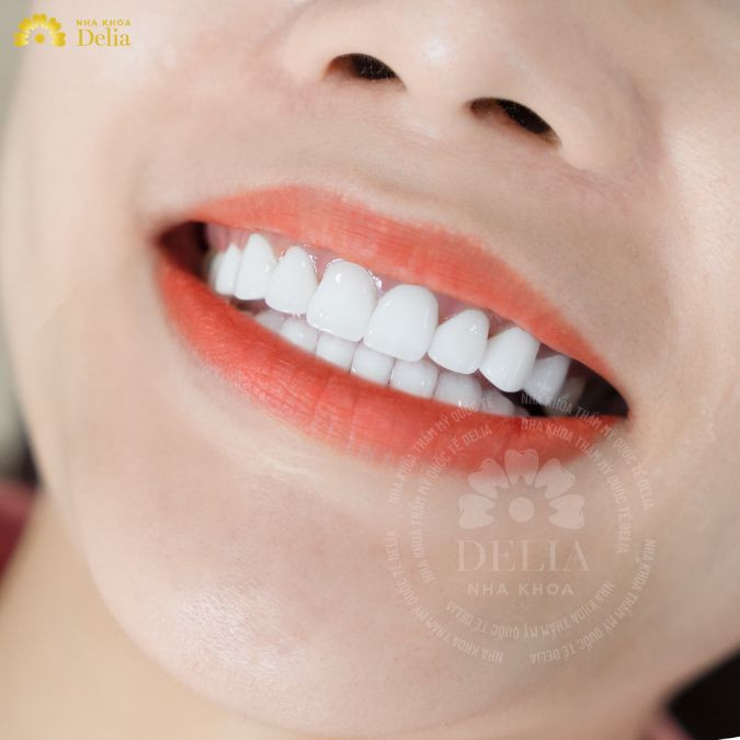 Sử dụng chanh để tẩy vết đen xuất hiện trên răng