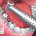 Trồng răng Implant và phục hình tức thì