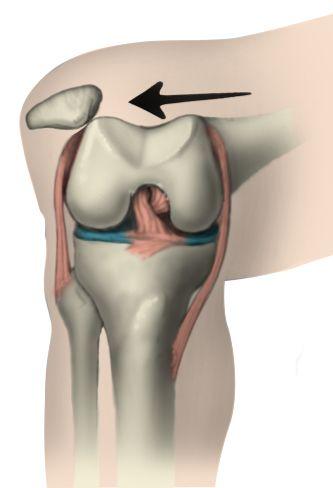 patellar dislocation