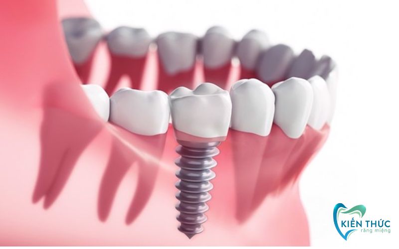 Vai trò của trụ Implant là thay thế chân răng đã mất