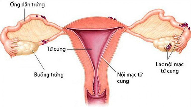 Góc giải đáp: U nang buồng trứng có thai được không? 3