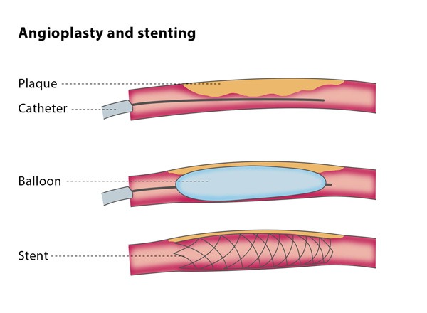 Angioplasty and stenting – CIRSE