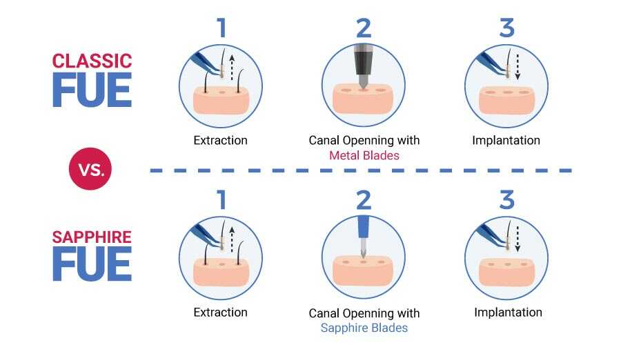 FUE Hair Transplant vs Sapphire FUE Hair Transplant