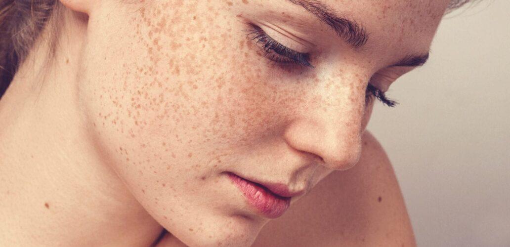 Melasma Archives | Aesthetic Clinic Perth