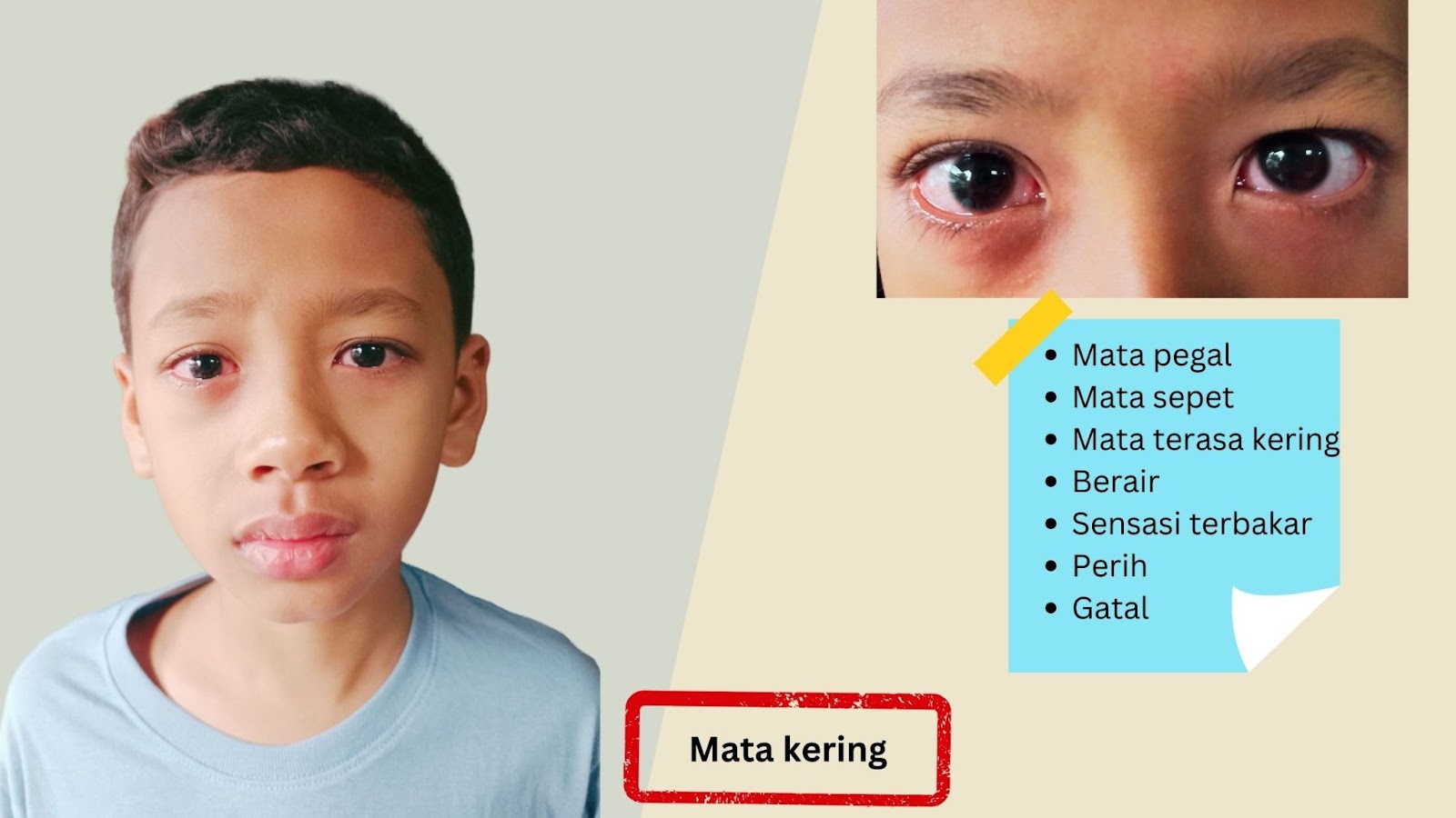 mata kering pada anak