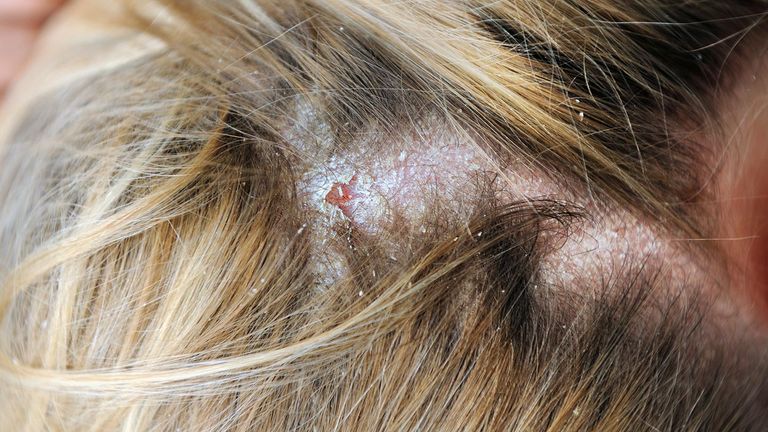 Skin-Conditions-You-Should-Know-About-06-Seborrhea-Dermatitis-1440x810
