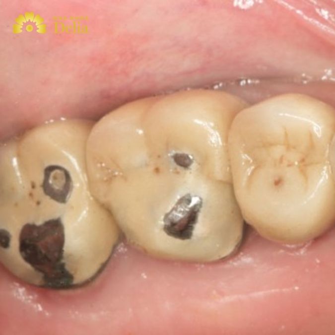 Tại sao có tình trạng răng sứ kim loại bị đen?