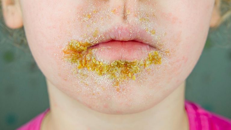 Skin-Conditions-You-Should-Know-About-05-Impetigo-1440x810