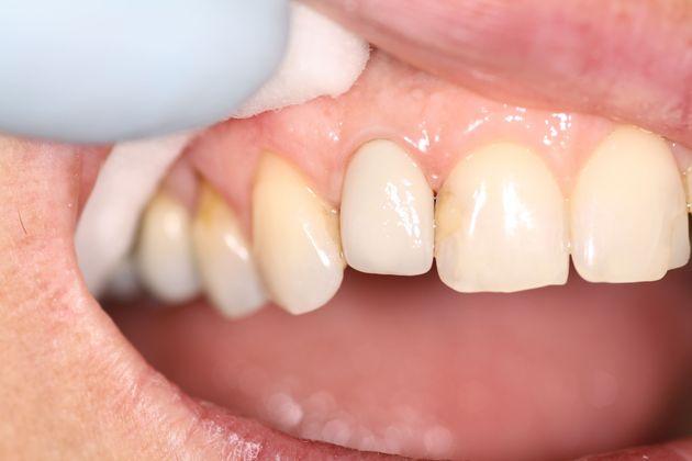 dental implants in Newmarket