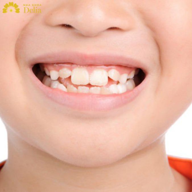 Răng món có thể cải thiện tính thẩm mỹ nhờ bọc sứ cho răng