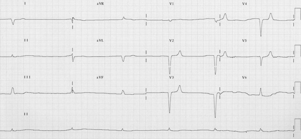 ECG Hyperkalemia junctional bradycardia potassium 8