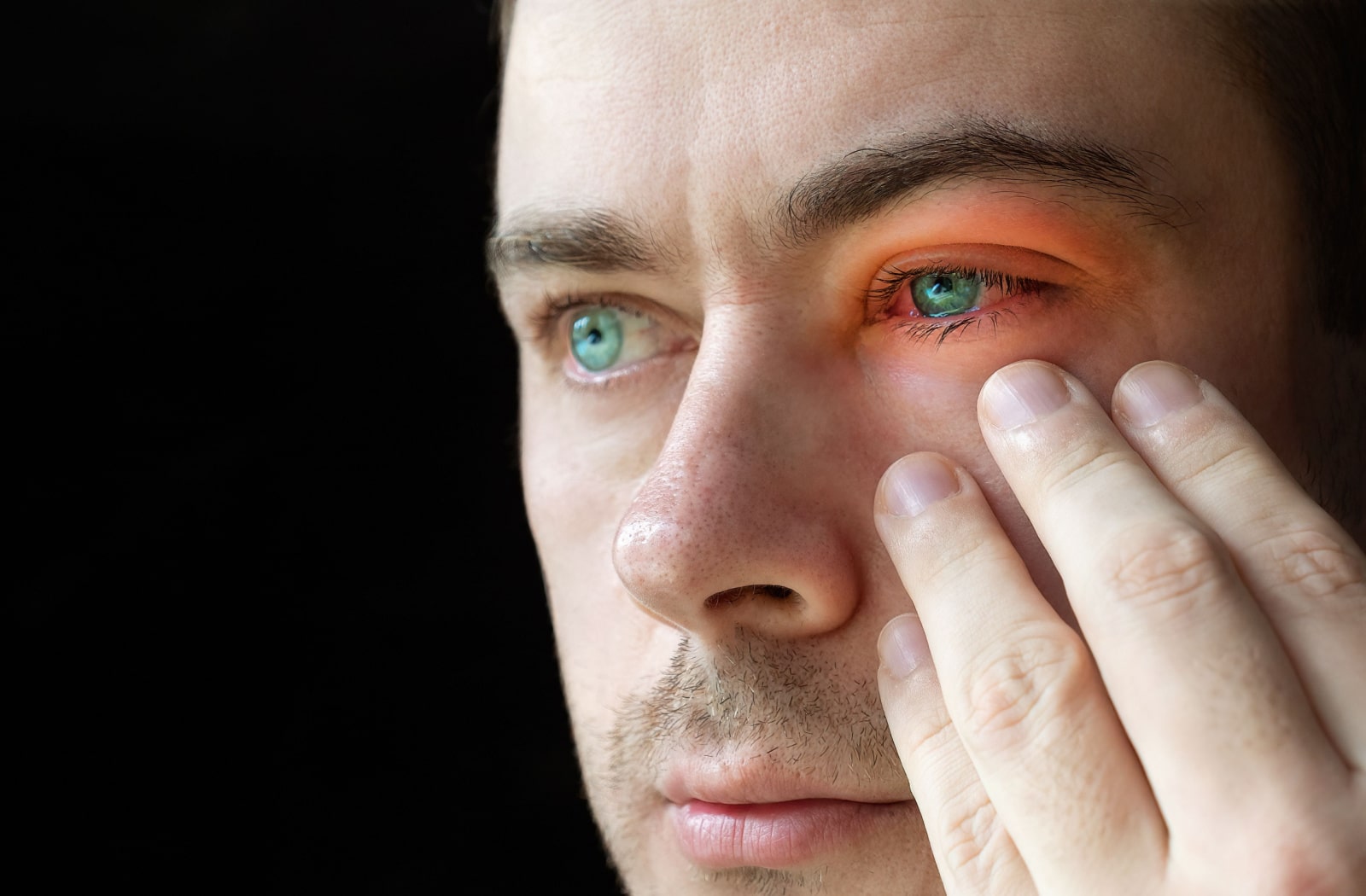A man puts his hand up by his red eye due to eye pain