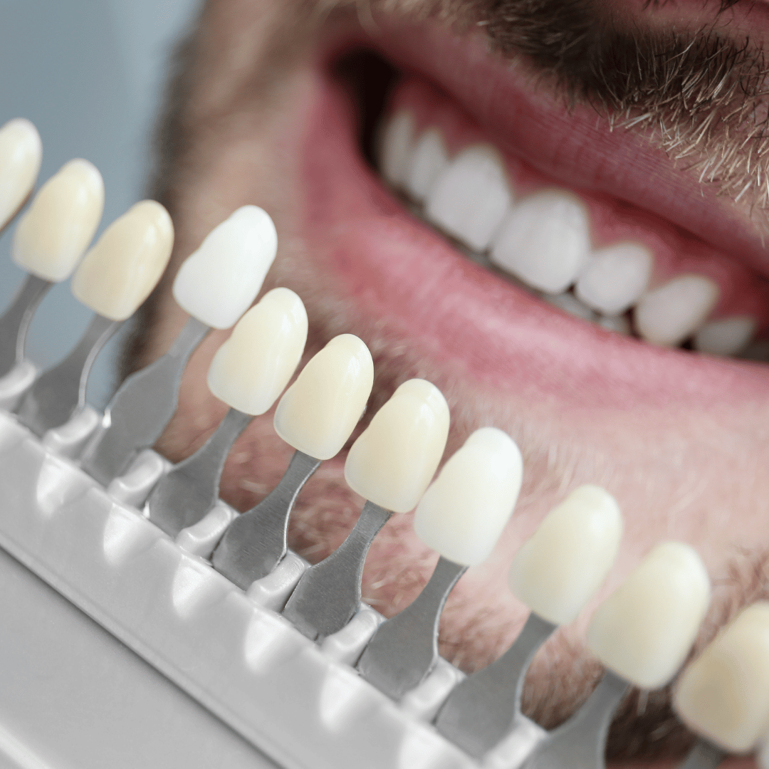 What is the Difference Between Veneers and Dentures?