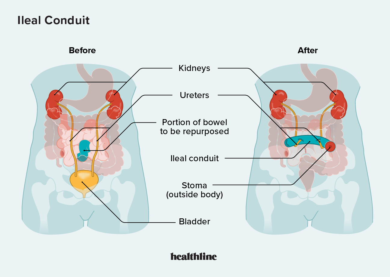 Ileal Conduit: Purpose, Procedure, and Care