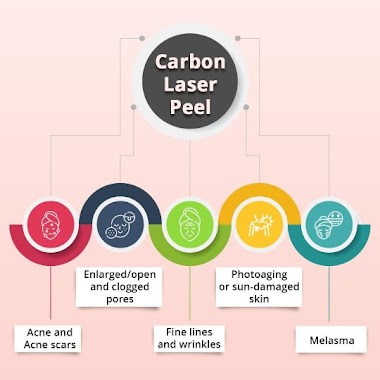 Carbon Laser Peel: A New Age Acne Management Procedure