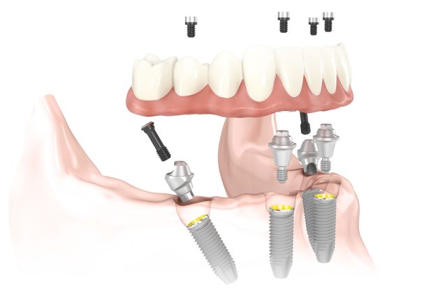 All On Four Dental Implants in Manhattan & Long Island