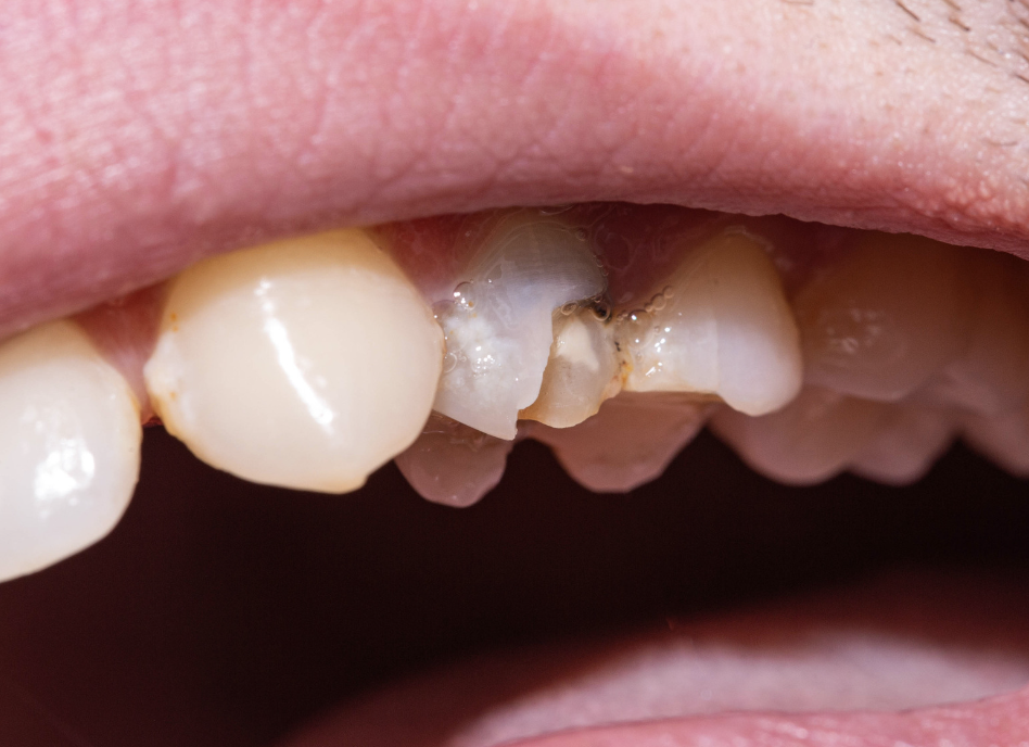 A damaged tooth