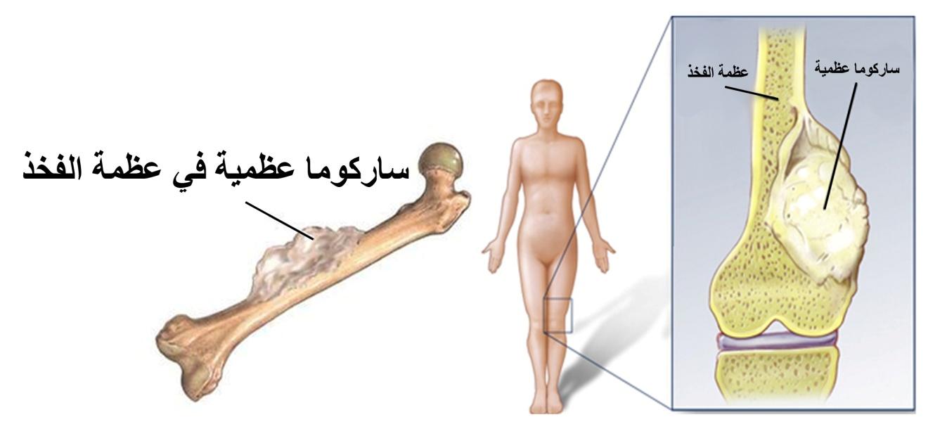 E:\Documents and Settings\USER\Desktop\Shared Files\bone cancer\ساركوما عظمية.jpg