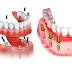 Trồng răng implant toàn hàm giá bao nhiêu? Đâu là yếu tố quyết định giá