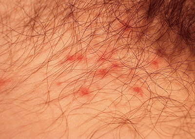 Figure 8. Folliculitis