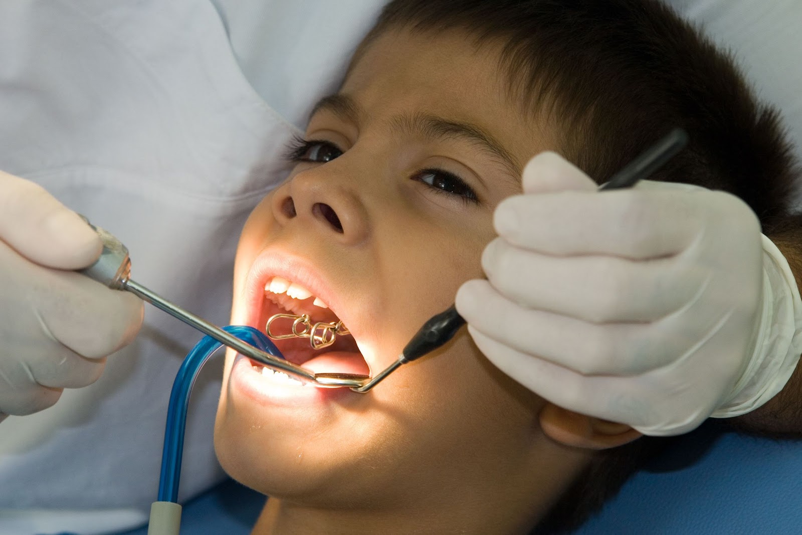 Dental Cavity Filling for Children  