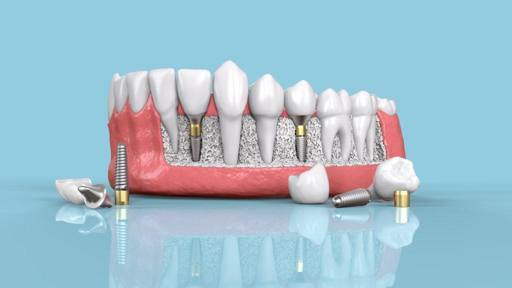 Dental Implants : types, surgery procedure, and cost