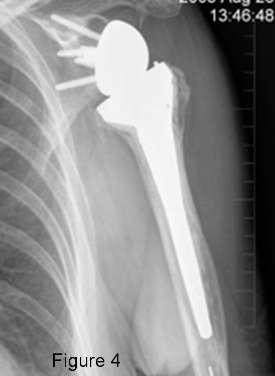X-ray showing a shoulder replacement