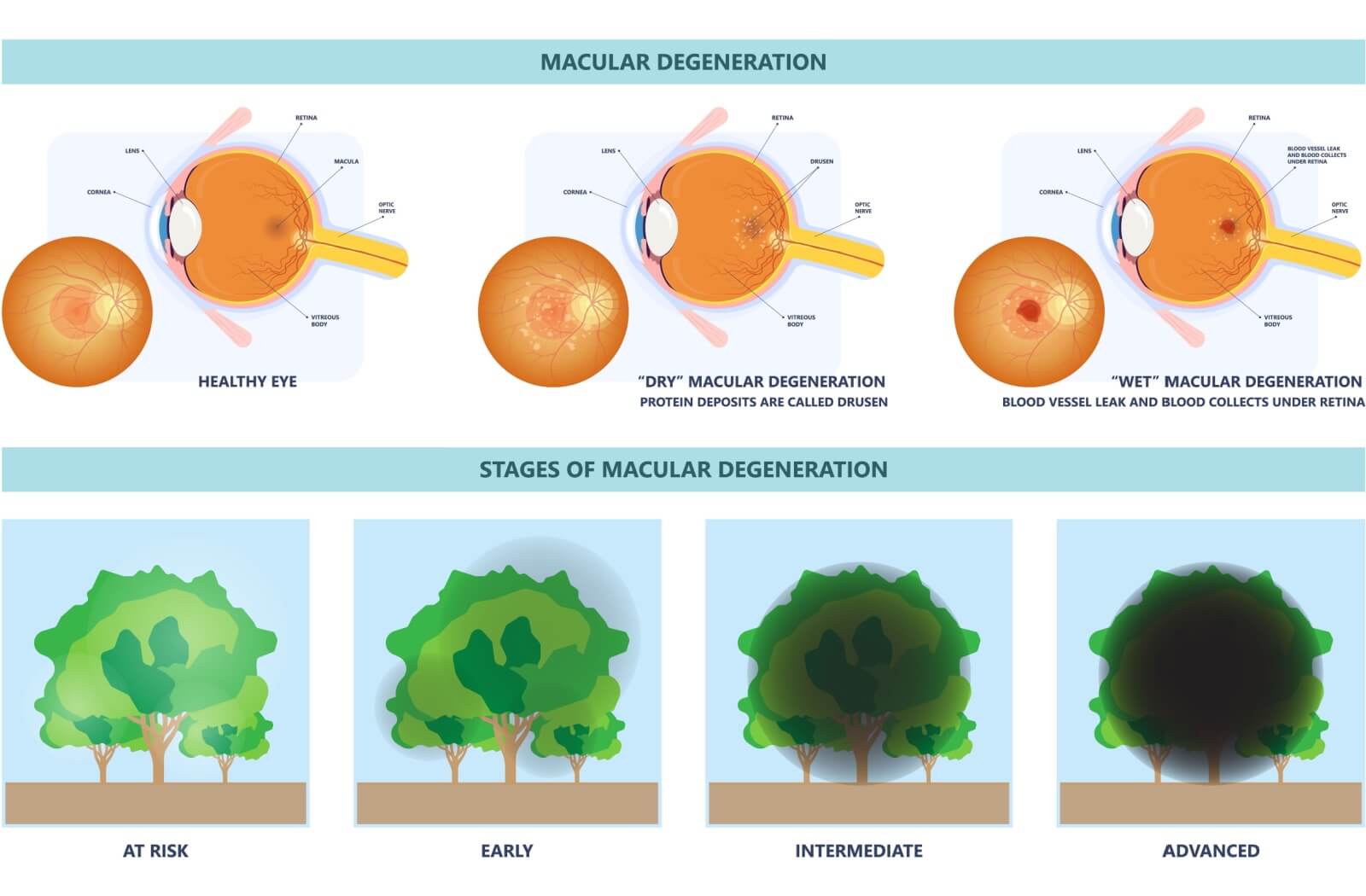 Image depicting the various stages of macular degeneration.