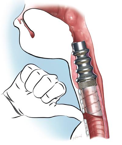 First human implantation of an artificial larynx | Scientist Live