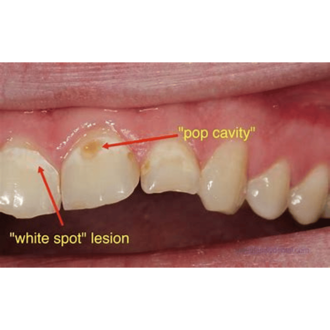 Cavity on Side of Tooth