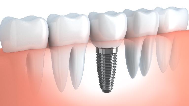 Dental implant clinic in Vancouver