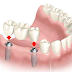 Đang sử dụng cầu răng sứ có thể trồng răng Implant Mỹ không?