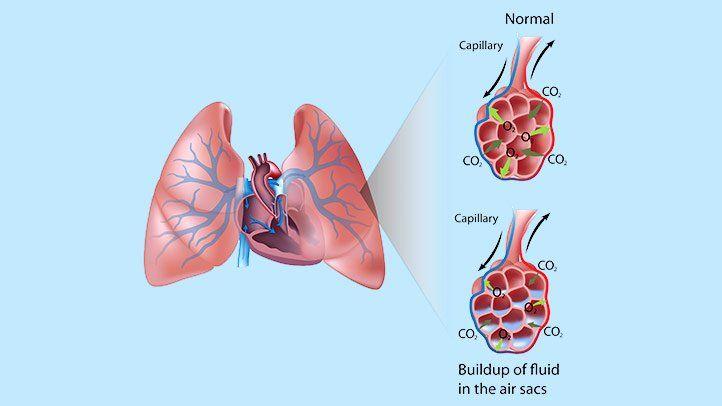 Pulmonary Edema: Symptoms, Diagnosis, Prevention