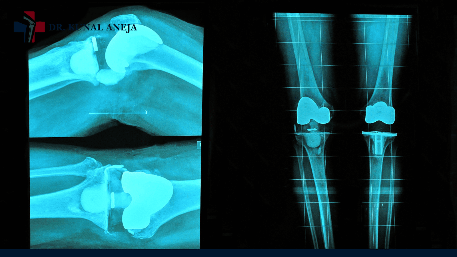 knee replacement surgeon in delhi
