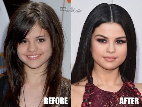 What kind of plastic surgery did Selena Gomez have? - Quora