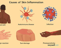 Inflammation