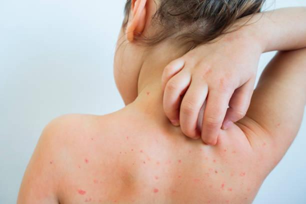 Chickenpox: Symptoms, Causes and Treatment - Dr Amal